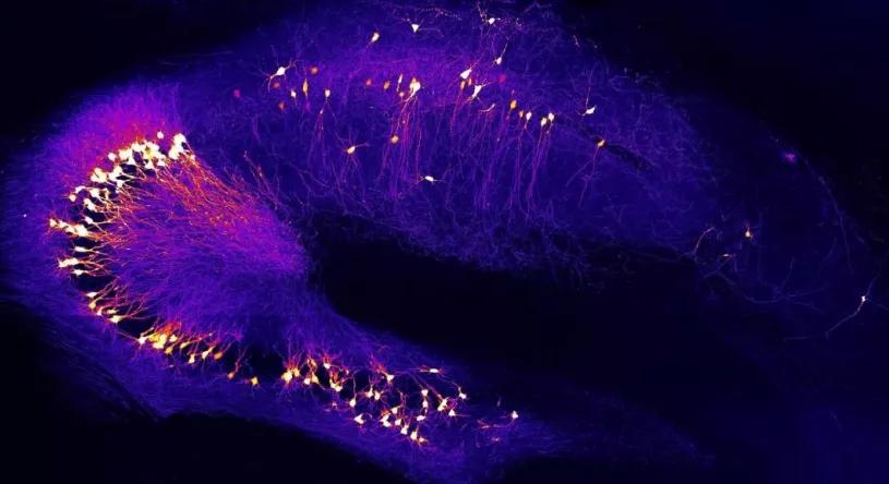 （大脑中负责学习和记忆的海马体的神经元出现损害）