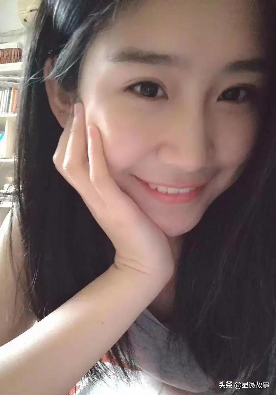 图 | 做完双眼皮以后的照片