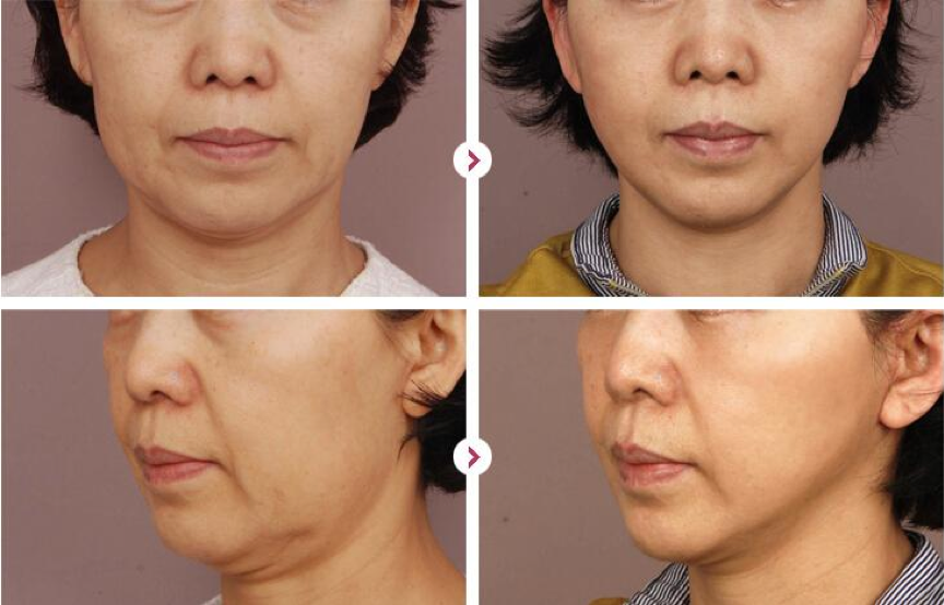 轻医美项目立竿见影的效果