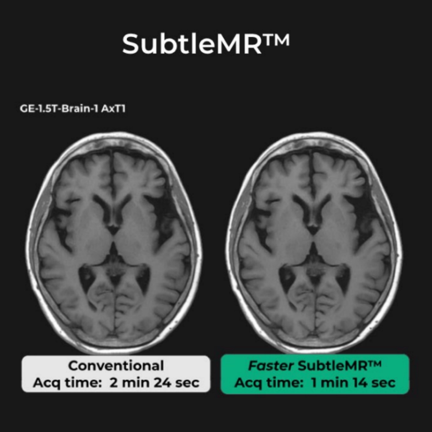 左为常规MRI扫描，右图中SubtleMR使得MRI扫描时间缩短，同时通过AI技术对图像质量进行增强