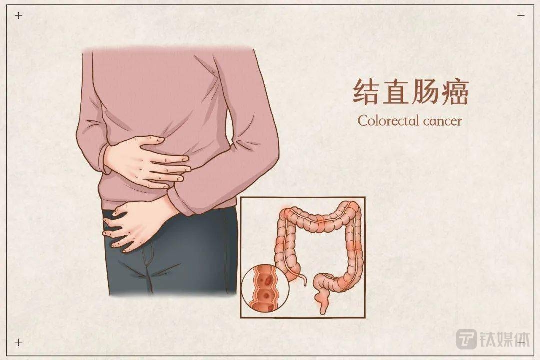 结直肠癌