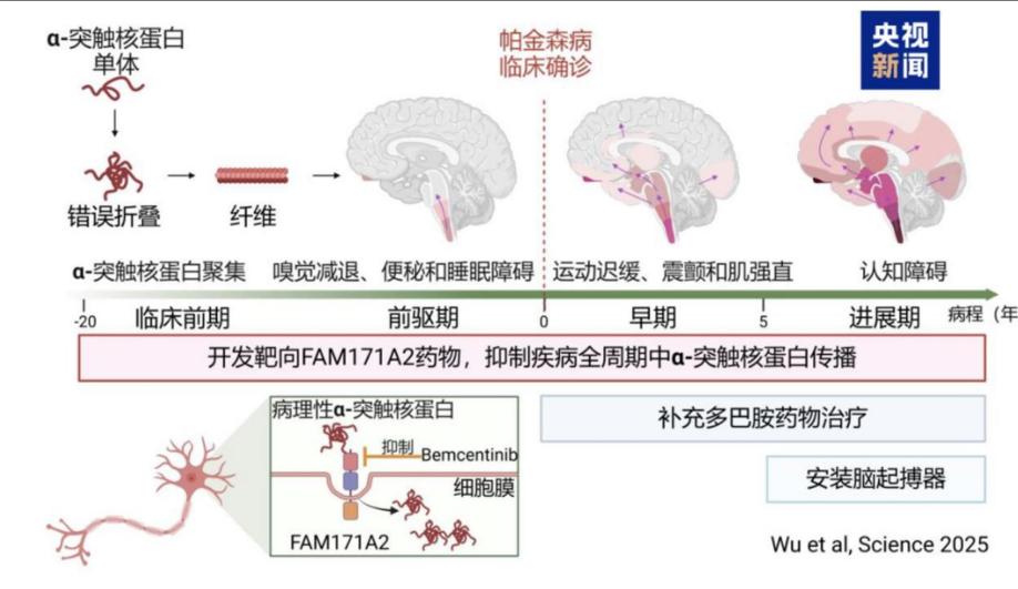 帕金森病为何没有特效药？