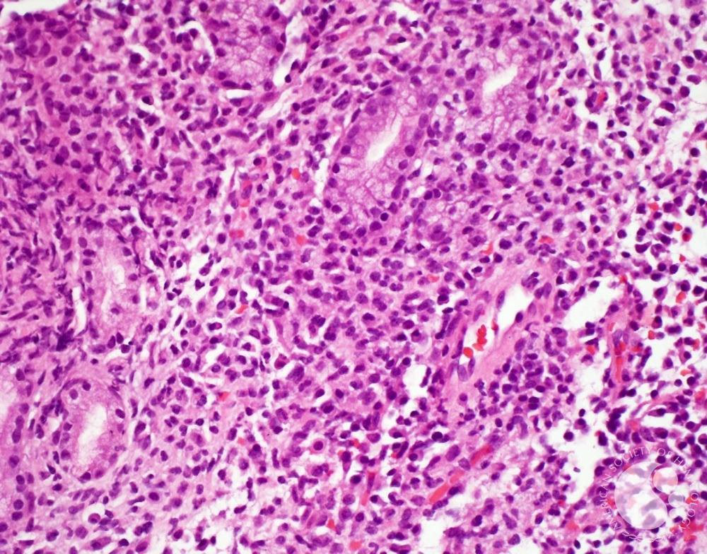 瑞士生物科技公司InCephalo研发能局部作用于胶质母细胞瘤的生物制剂，提升药物局部停留时间与浓度