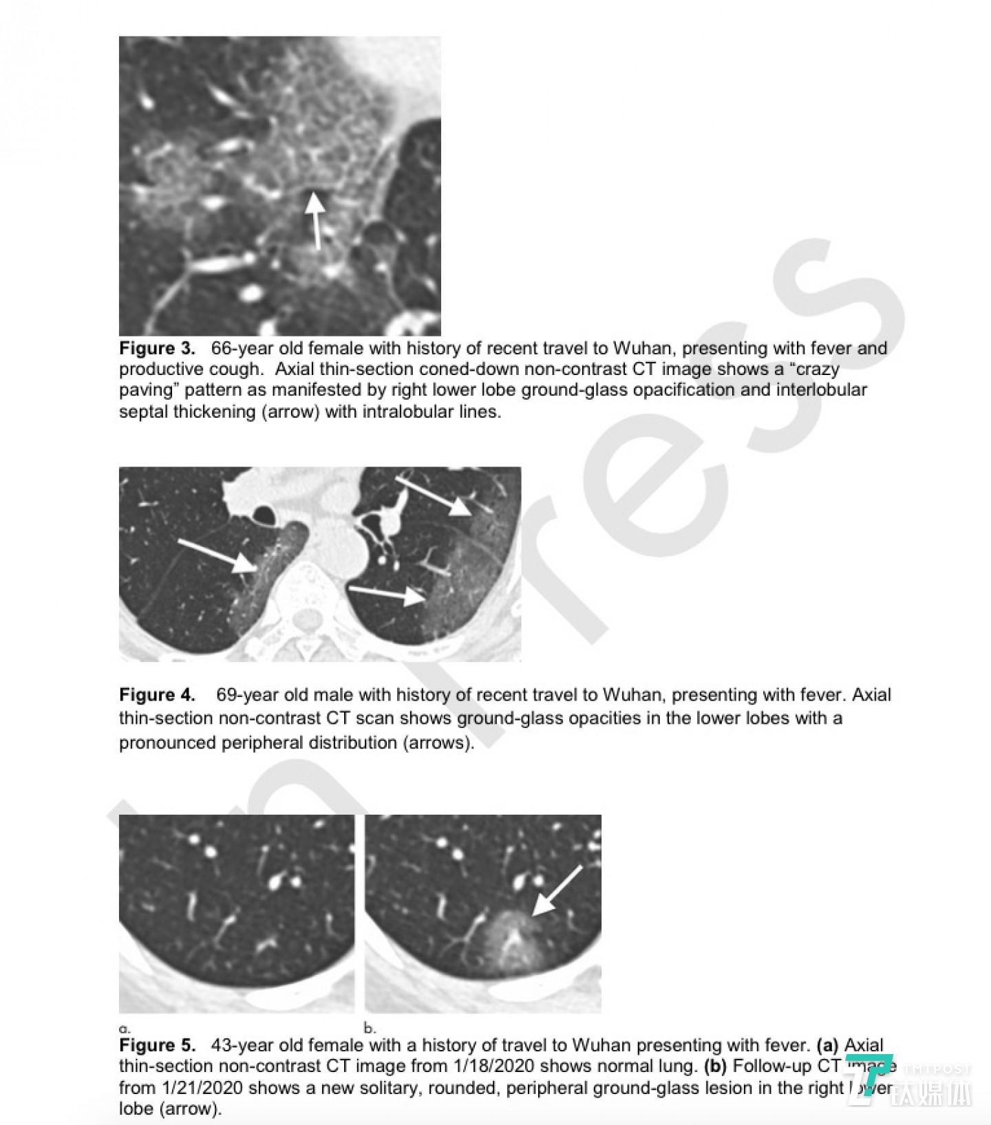 其中3名患者的CT图像，图5图5。43岁的女性，曾到武汉旅行，发烧。  （a）从2020年1月18日开始的轴向薄层CT扫描显示肺部正常。  （b）2020年1月21日的CT随访图像显示右下角出现新的孤立的，圆形的周围毛玻璃样病变  瓣（箭头）。