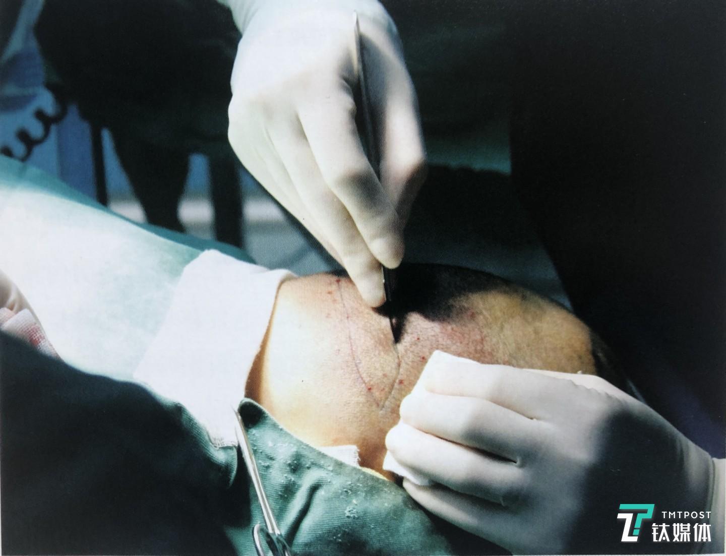 圖片來自《頭面部毛發(fā)美學(xué)種植與文飾》