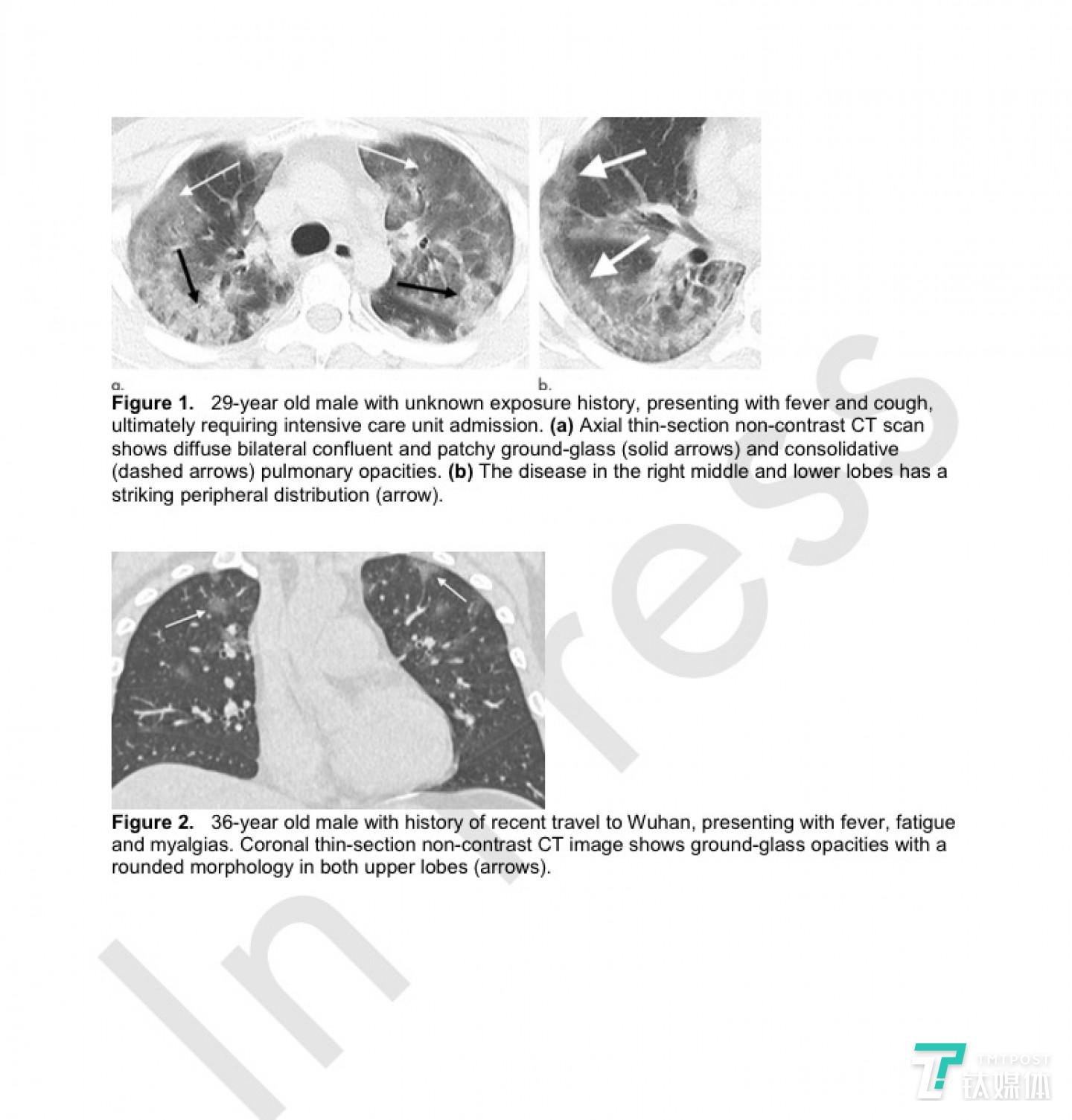 其中两名患者的CT图像图，图1是一位29岁的男性患者，暴露史未知，表现为发烧和咳嗽，最终需要重症监护病房。（a）轴向薄层非对比CT扫描显示弥漫性双侧融合和片状毛玻璃（实线箭头）和合并（虚线箭头）肺部混浊。（b）该病在右中叶和下叶有明显的周围分布（箭头）。图2